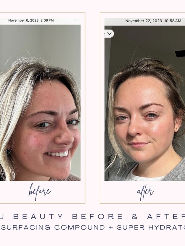 Chicago beauty influencer Bows & Sequins shares before and after pics from using U Beauty's Resurfacing Compound and Super Hydrator.