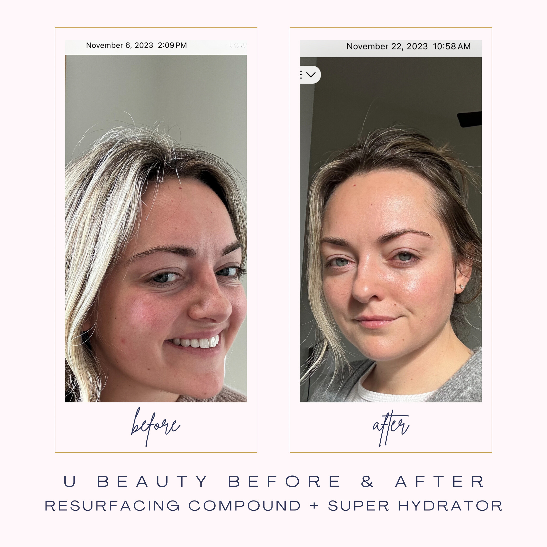 Before and after skin results after two weeks of using U Beauty Resurfacing Compound and Super Hydrator